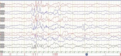 Case Report: Congenital disseminated tuberculosis neonate born to tuberculosis- COVID-19 mother